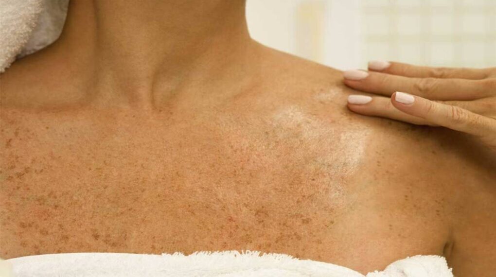 ¿Tienes manchas en la piel? Estos seis remedios caseros te ayudarán a reducirlas